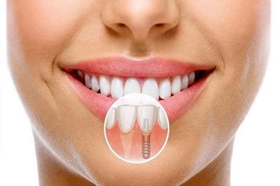 Kas ir labāk: uzstādīt implantu vai izārstēt savu zobu?