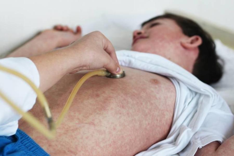 SPKC apzinājis ar masalām saslimušā cilvēka kontaktpersonas Latvijā